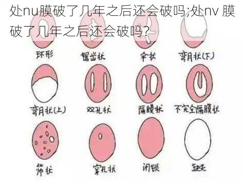 处nu膜破了几年之后还会破吗;处nv 膜破了几年之后还会破吗？